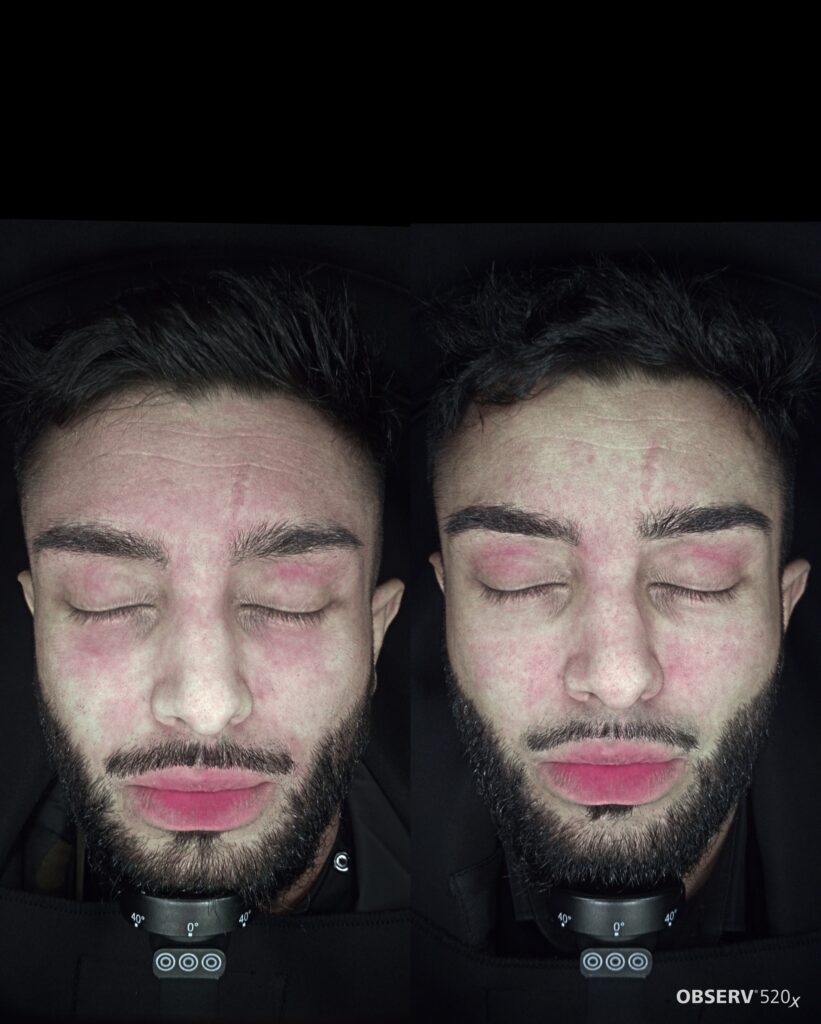 Before-and-after skin analysis showing vascular inflammation and redness improvement in male patient under OBSERV® 520x imaging.